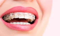 Diş teline avantajlı alternatif: Şeffaf plaklar