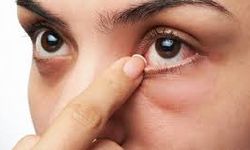 Bahar aylarındaki göz alerjisi görme kaybına yol açabilir