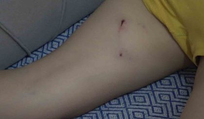 Çocuk, sokak köpeğinin saldırısına uğradı