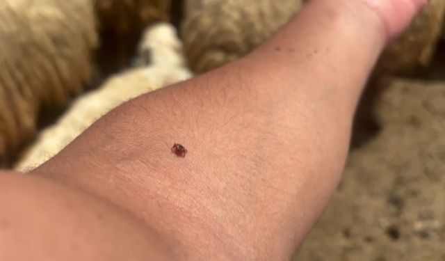 Kene tutundukça, hastalık riski artıyor