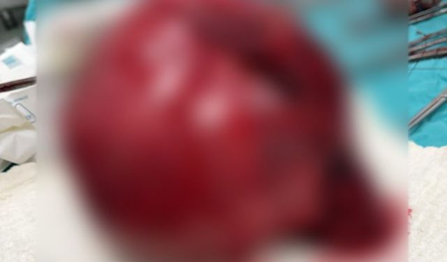 Niğde’de 7 kiloluk dev tümör başarıyla alındı
